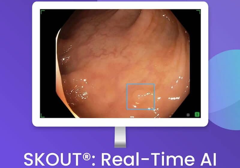 SKOUT: Real-Time AI for Polyp Detection
